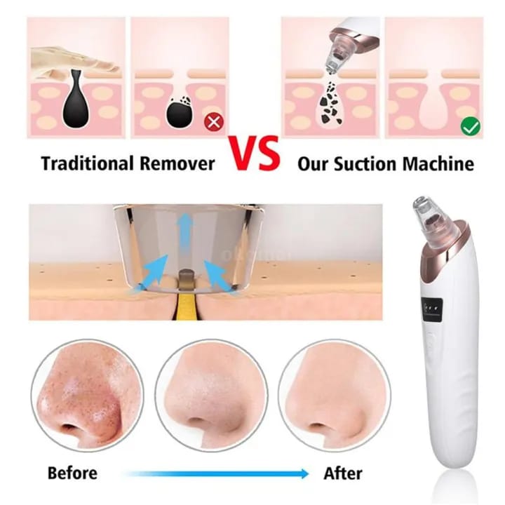 5-in-1 Electric Blackhead Remover – Deep Cleansing Blackhead & Pore Remover for Nose & Face